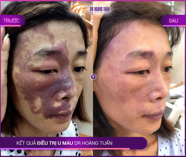 Kết quả trị u máu - bớt máu